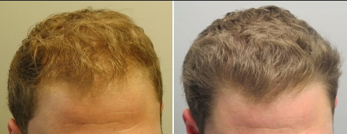 provillus results before after