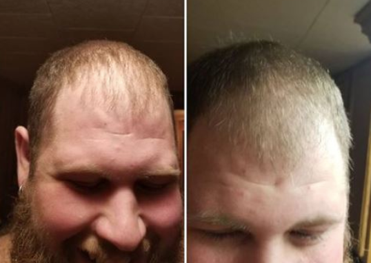 cbd oil for hair loss in men